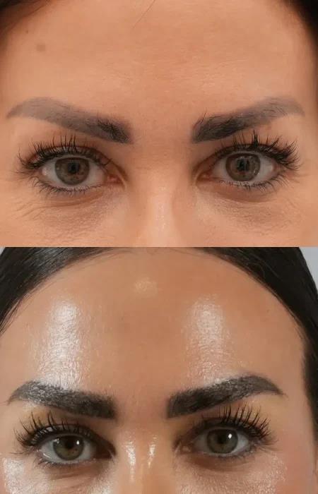 مقایسه کاشت ابرو و میکروبلیدینگ؛ مزایا و معایب هر روش